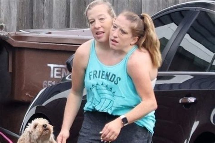 Are Abby and Brittany still conjoined?