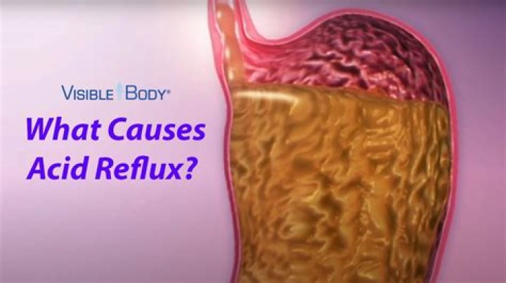Can hoarseness be caused by acid reflux?