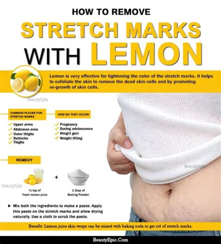 Can Lemon remove stretch marks?