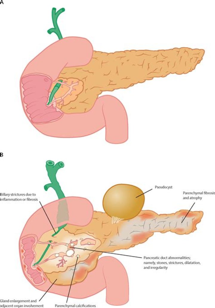 Can pancreatitis affect breathing?