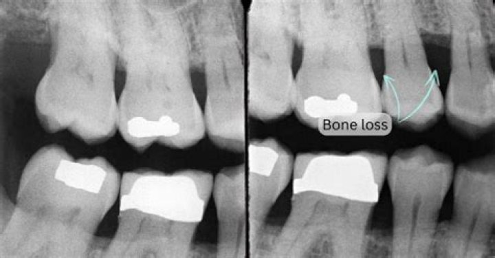 Can you see bone loss on an X-ray?