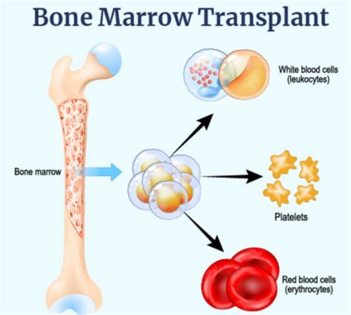 Does blood type matter for bone marrow transplant?