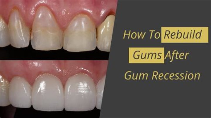 How do I fix my shrinking gums?