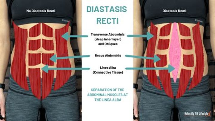 How do I know if I have diastasis recti NHS?