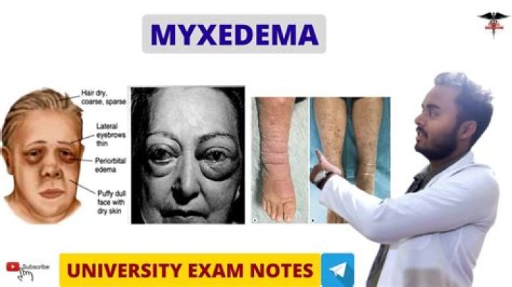 How do I know if I have myxedema?