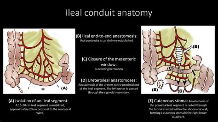 How do you control an ileal conduit?