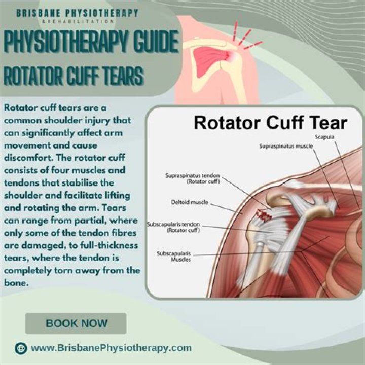 How do you describe a rotator cuff tear in an MRI?