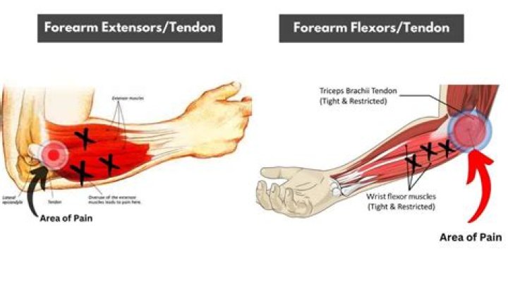 How do you know if you have a flexor tendon injury?