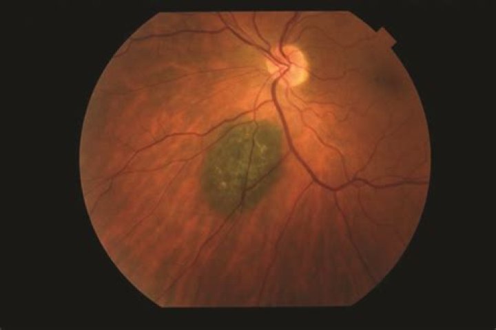 How do you treat Vellus cyst?