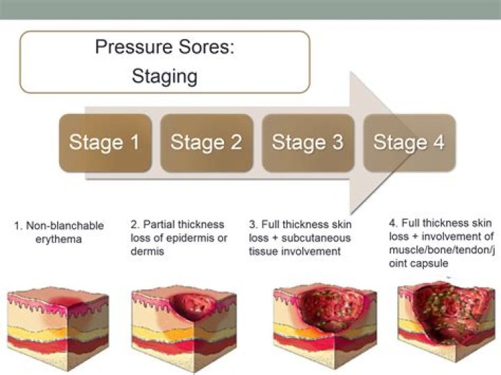 How is a Stage 3 ulcer categorized?