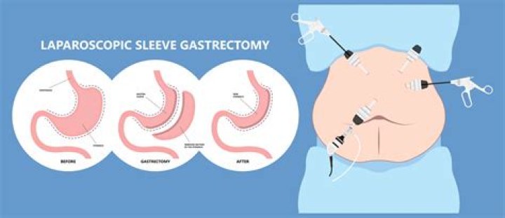 How is UPPP surgery performed?