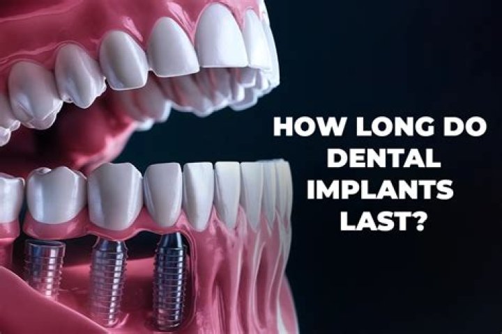 How long do permanent lip implants last?