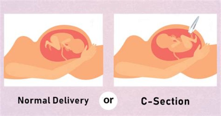 How long does a C-section take with twins?