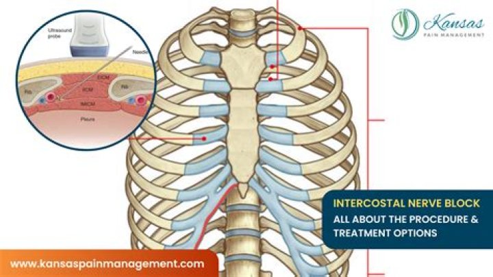 How long does a nerve block last for sciatica?