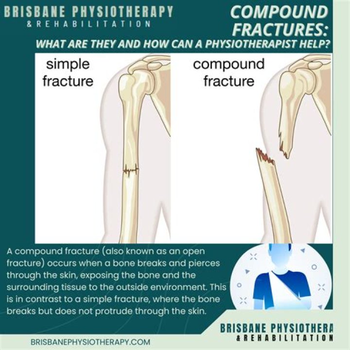 How long does it take for a compound fracture in your back to heal?