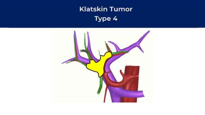 Is Klatskin tumor curable?