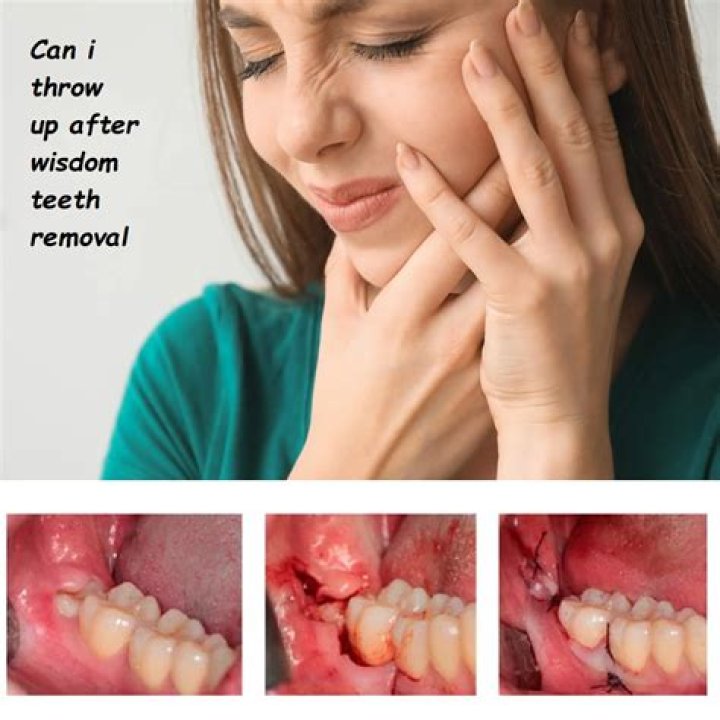What are the side effects of getting your wisdom teeth removed?