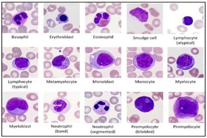 What can cause high lymphocytes and low neutrophils?