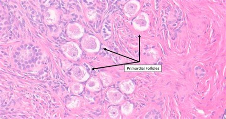What causes atretic ovarian follicle?