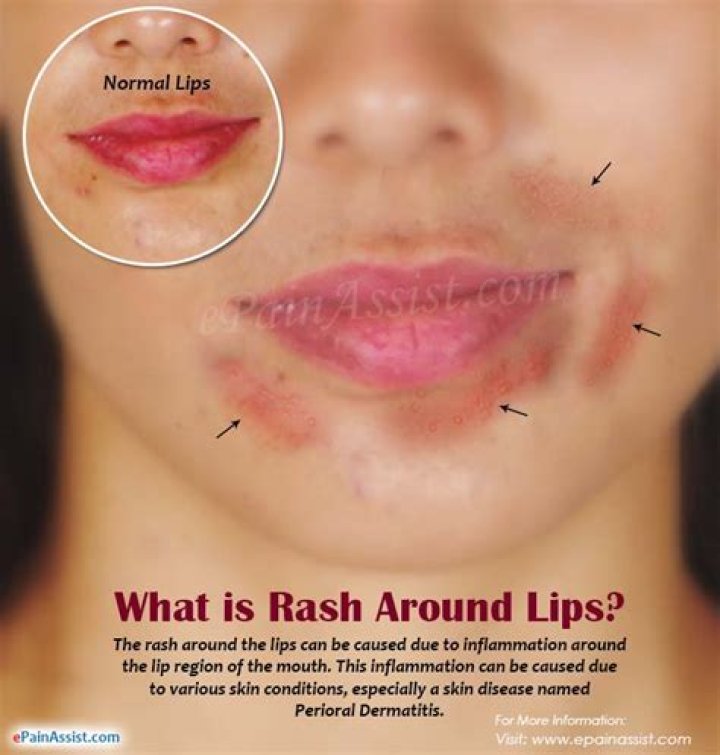 What causes rash around mouth and chin?