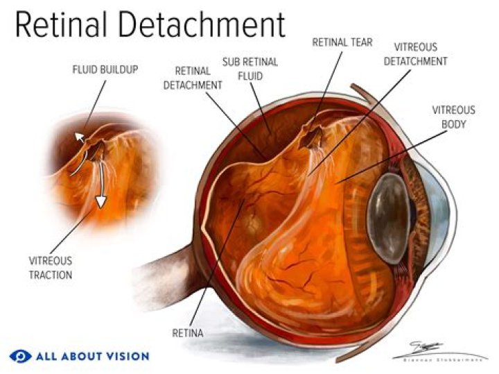 What causes retinal exudate?