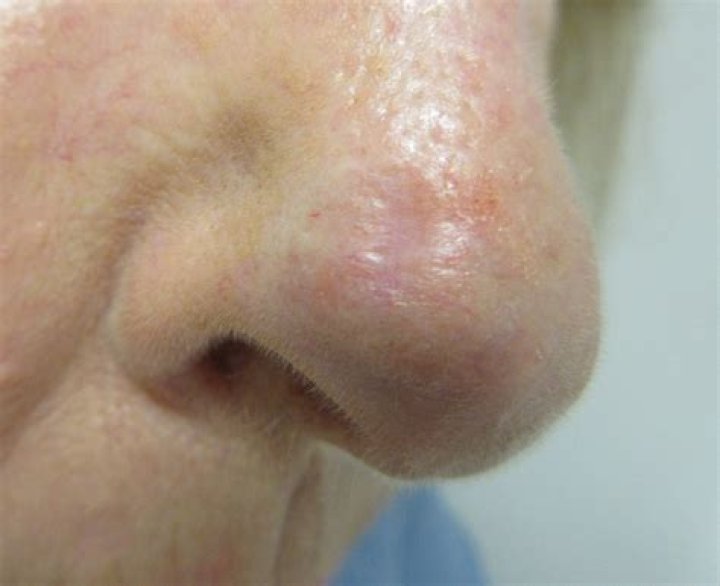 What does a failed skin graft on nose look like?