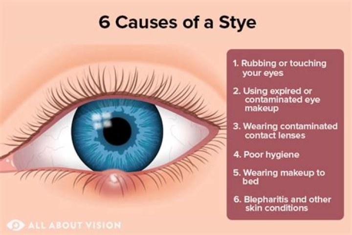 What does an eye stye look like?