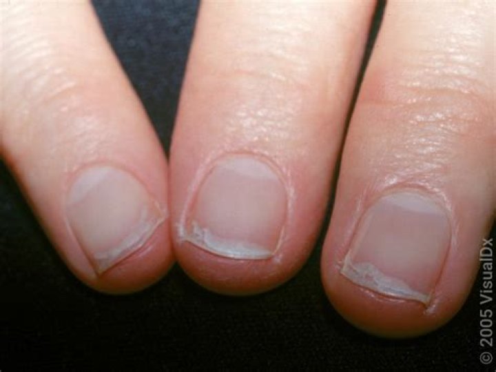 What does onychorrhexis look like?