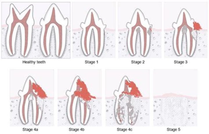 What does resorption mean?