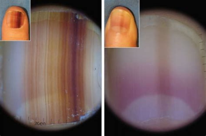 What does Subungual melanoma look like?