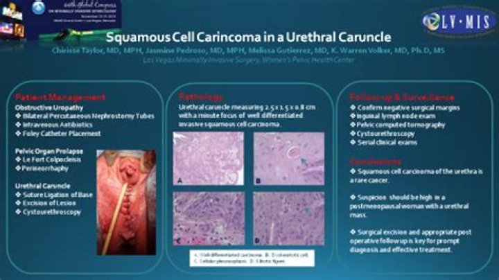 What is a urethral Caruncle?