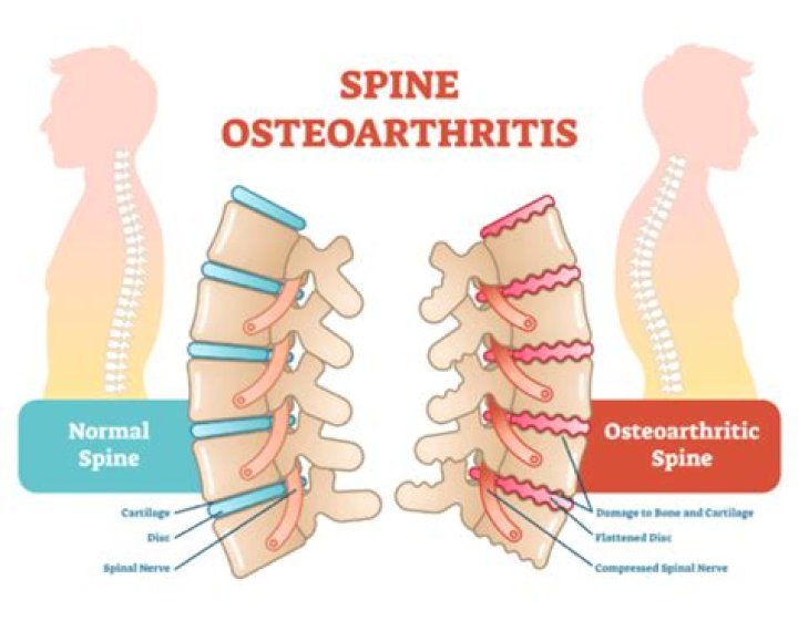 What is degenerative osteoarthritis of the thoracic spine?