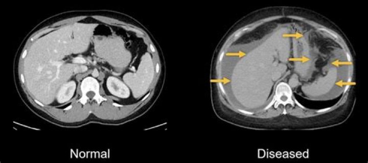 What is endofibrosis?