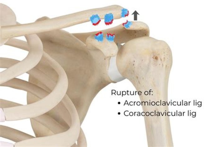 What is hypertrophic degenerative changes acromioclavicular joint?