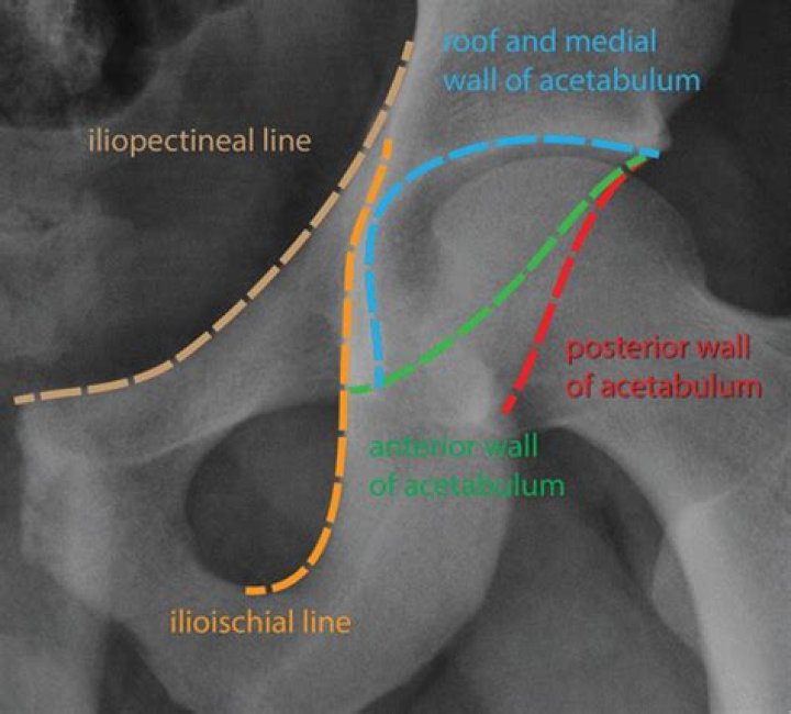 What is Iliopectineal Arch?