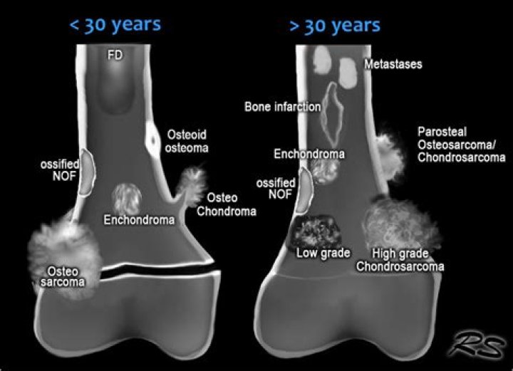What is meant by osteosarcoma?