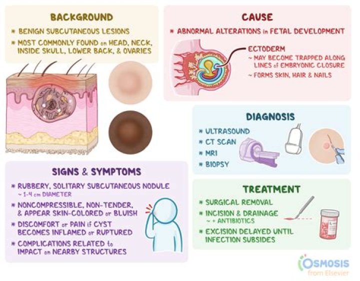 What is sequestration dermoid?