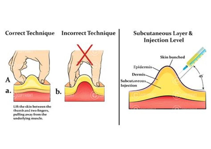 What is the correct subcutaneous injection technique?