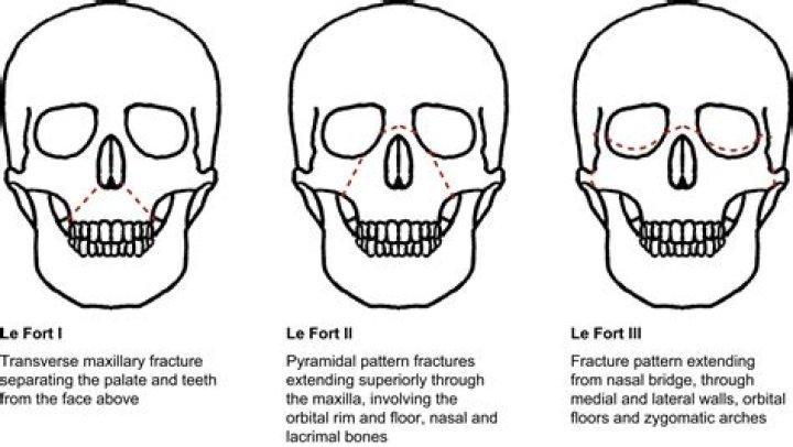 What is the difference between LeFort 1 2 and 3?