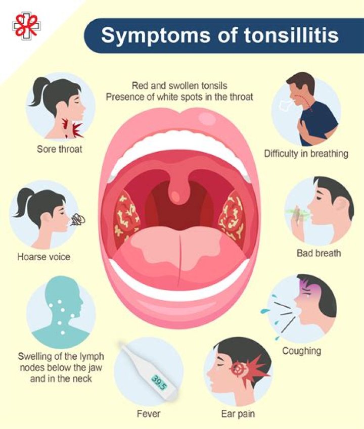 What is the most common complication of tonsillitis?