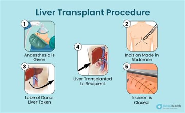 What qualifies you for a liver transplant?