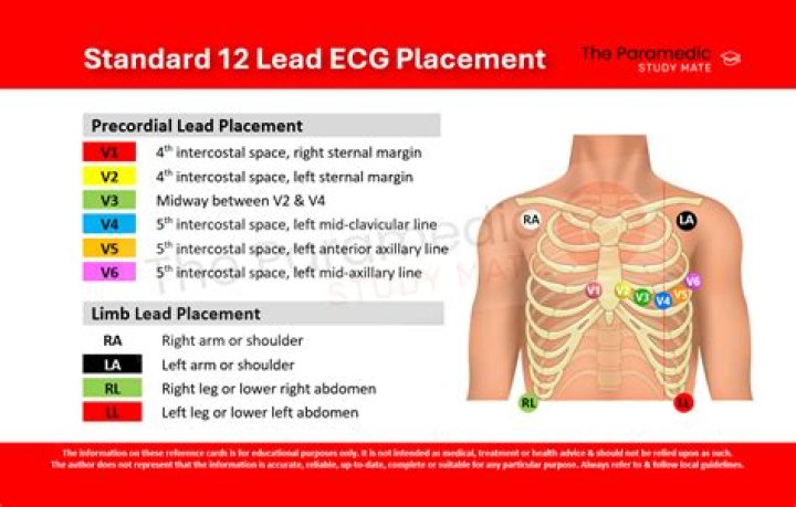 Where does lead 1 go on ECG?